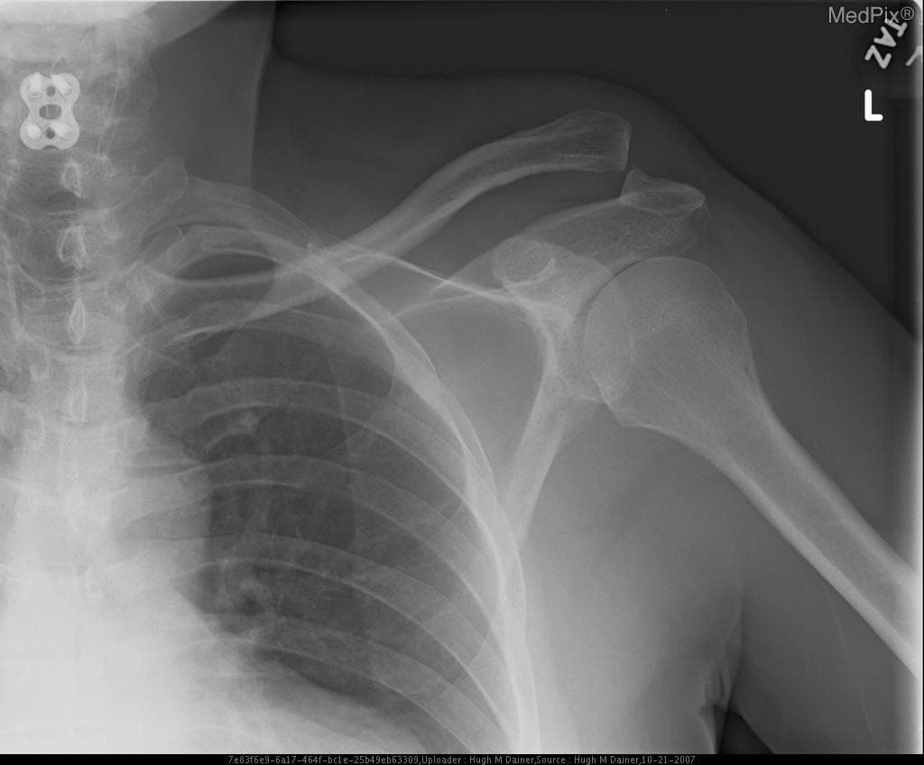 Case Study:  Acromioclavicular Dislocation
