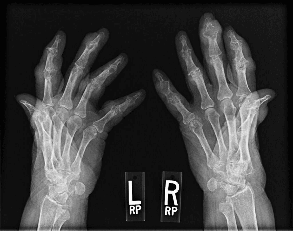 x-ray of left and right hands