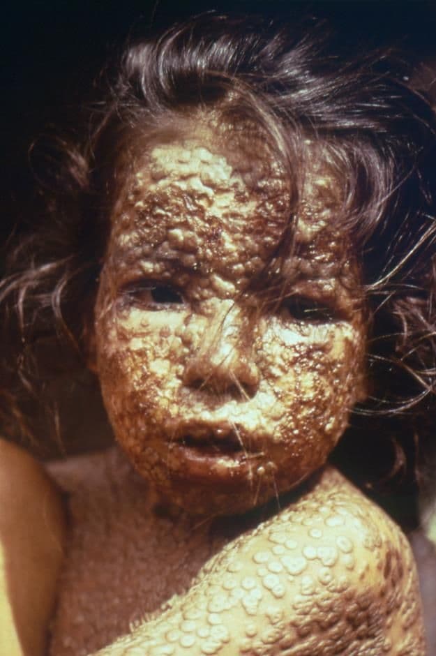 a closeup of a little girl's face, affected by smallpox